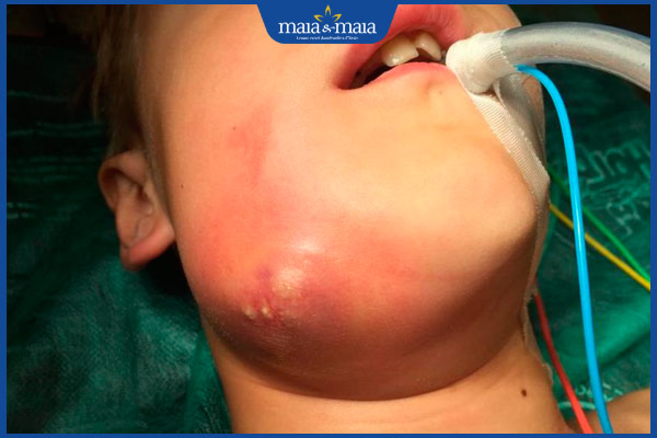 viêm mô răng nặng