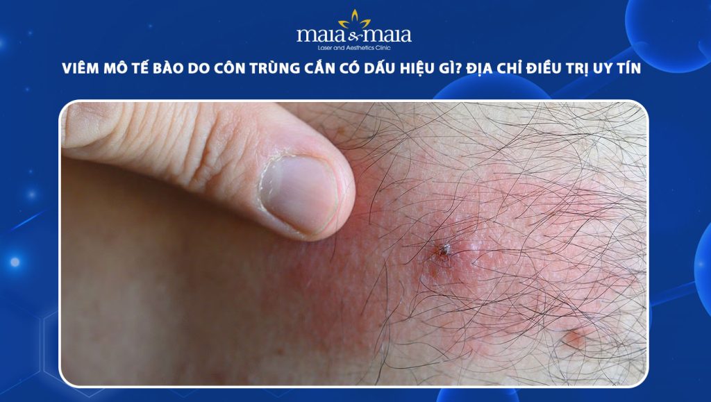 viêm mô tế bào do côn trùng cắn