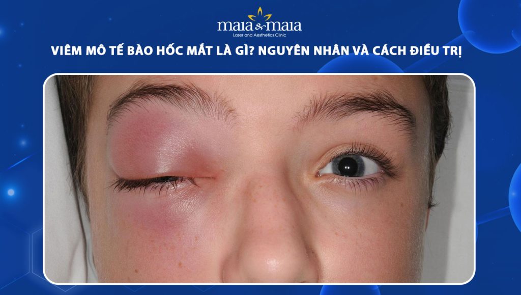Viêm mô tế bào hốc mắt là gì? Nguyên nhân và cách điều trị 1 viêm mô tế bào hốc mắt