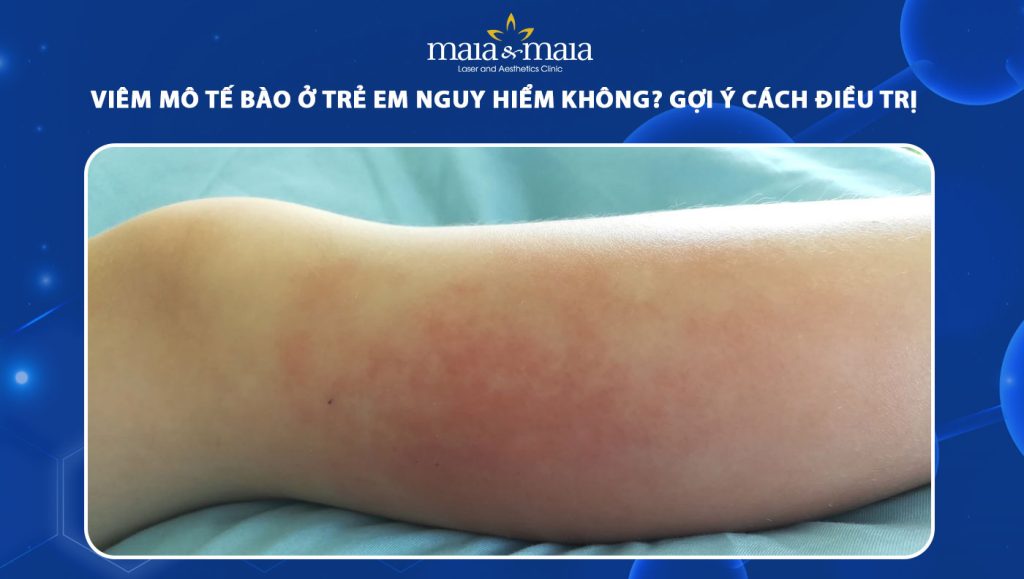 viêm mô tế bào ở trẻ em