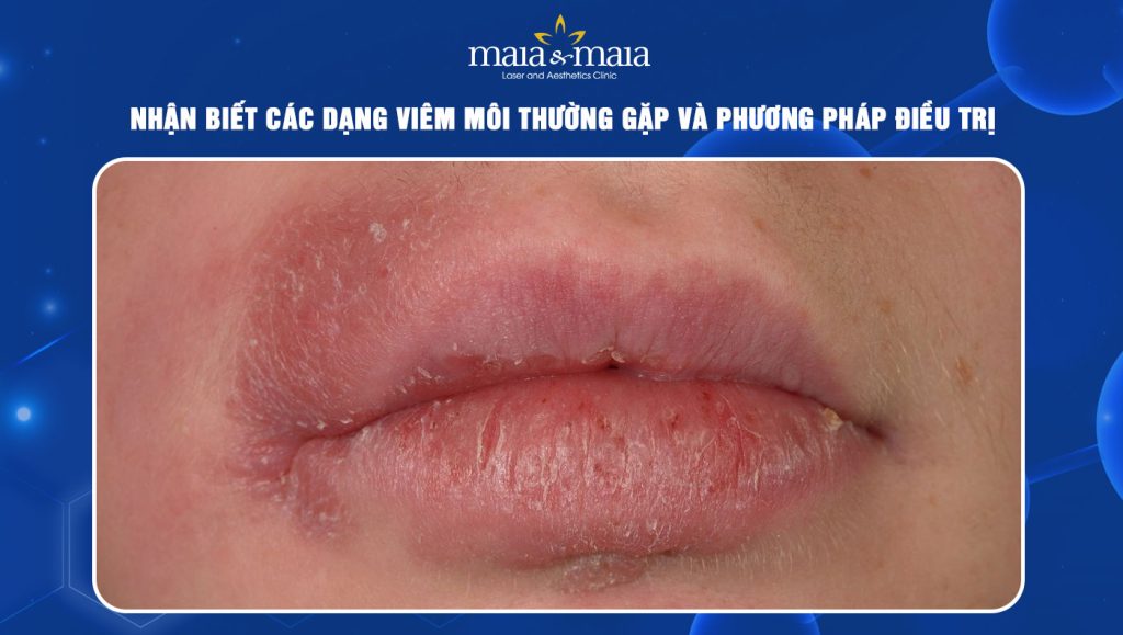 Nhận biết các dạng viêm môi thường gặp và hướng điều trị 1 Viêm môi
