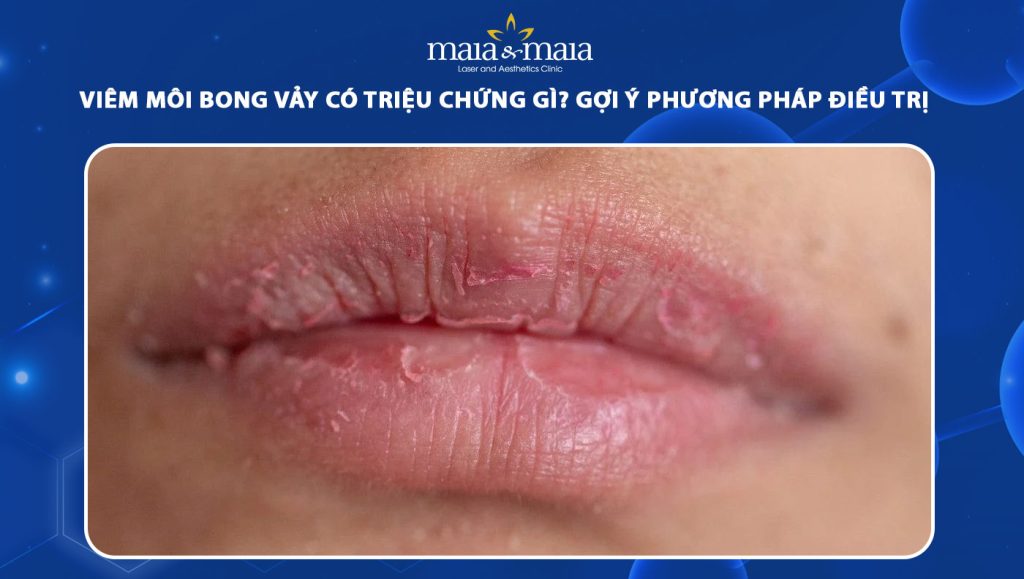 viêm môi bong vảy