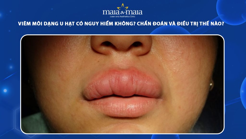 Viêm môi dạng u hạt có nguy hiểm không? Cách xử lý hiệu quả 1 viêm môi dạng u hạt
