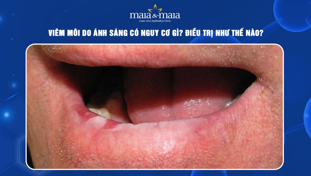 Viêm môi do ánh sáng có nguy cơ gì? Điều trị như thế nào? 1 viêm môi do ánh sáng