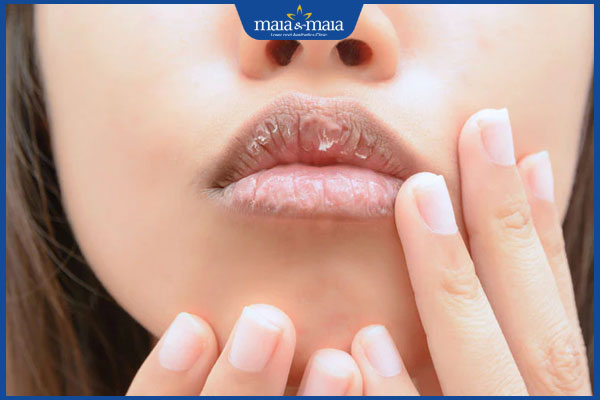 viêm môi tróc vảy