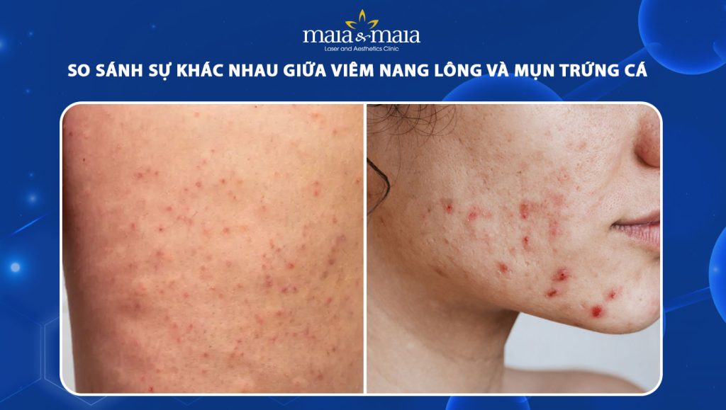 viêm nang lông và mụn trứng cá