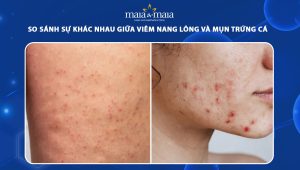 viêm nang lông và mụn trứng cá