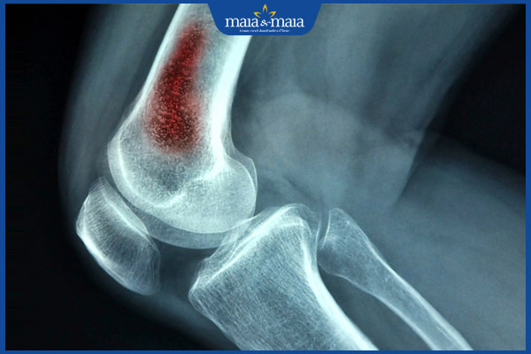 Viêm mô tế bào: Phương pháp chẩn đoán và điều trị hiệu quả 8 viêm tủy xương