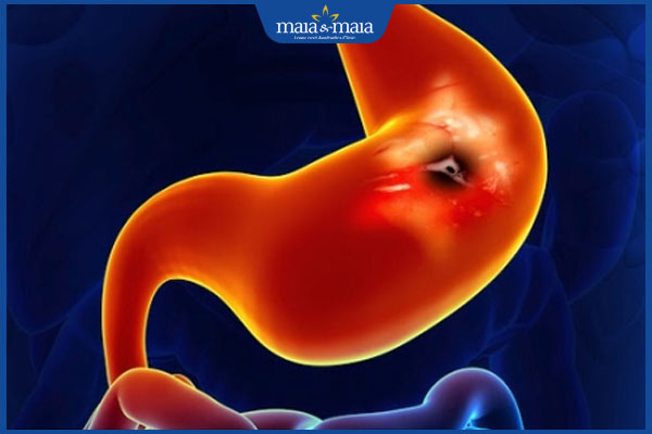 xuất huyết tiêu hóa