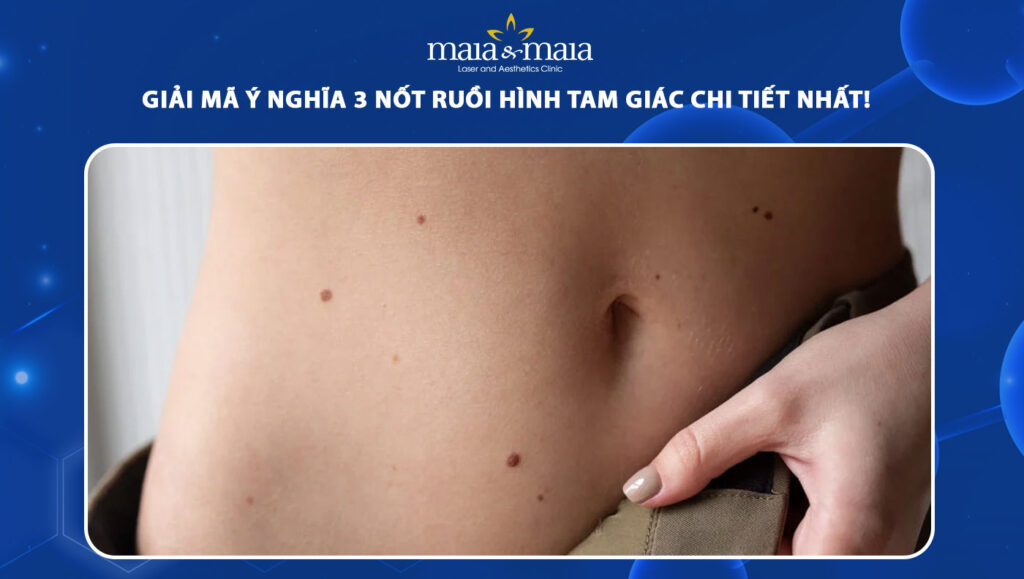 3 nốt ruồi hình tam giác