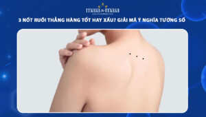 3 nốt ruồi thẳng hàng