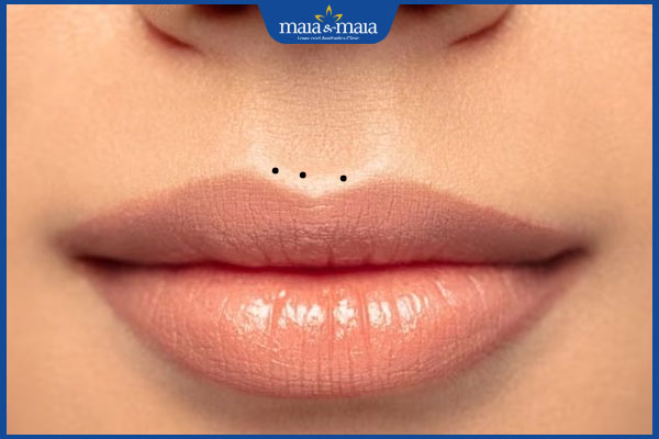 3 nốt ruồi thẳng hàng ở nhân trung