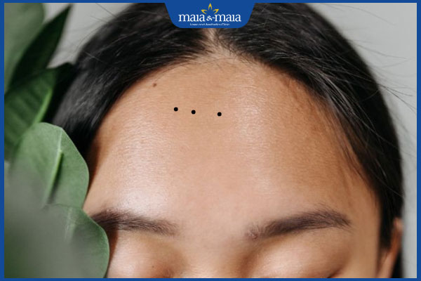 3 nốt ruồi thẳng hàng trên trán