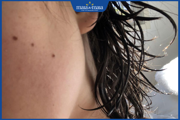 3 nốt ruồi thẳng hàng trên mặt