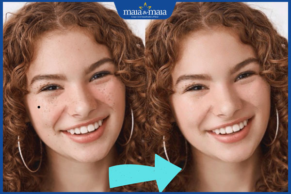 app xóa nốt ruồi