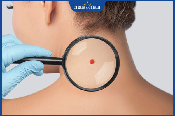 bác sĩ khám nốt ruồi son