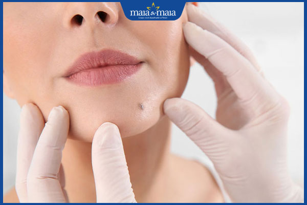 Tẩy nốt ruồi bao lâu thì bong vảy? Cách để vảy bong nhanh 5 bác sĩ khám nốt ruồi trên mặt