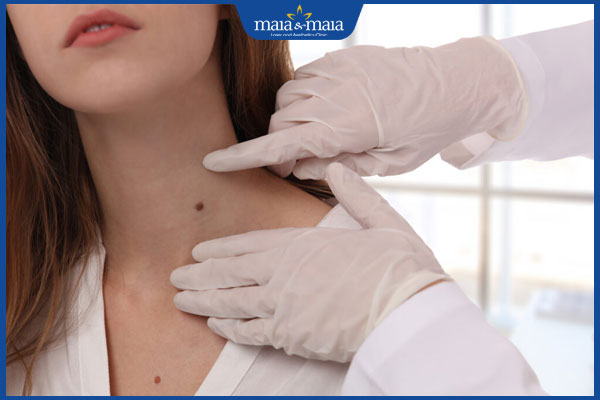 6 cách tẩy nốt ruồi tại nhà phổ biến và hiệu quả thực tế 5 bác sĩ khám nốt ruồi