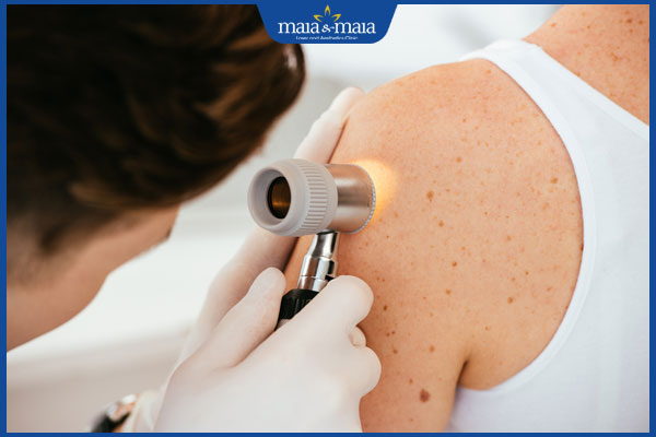 Tẩy nốt ruồi bằng laser CO2: Hiệu quả, quy trình và chi phí 4 bác sĩ soi nốt ruồi