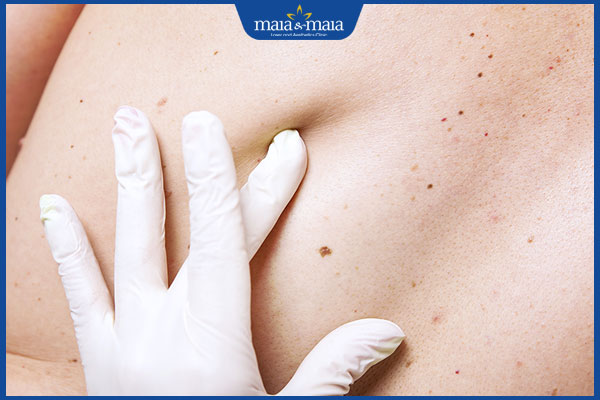 bác sĩ tư vấn xóa nốt ruồi