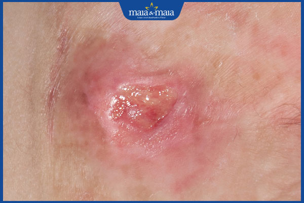 bị loét da do tỳ đè