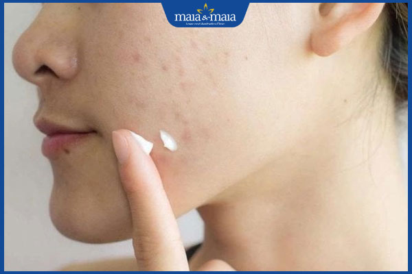 Tẩy nốt ruồi bằng laser CO2: Hiệu quả, quy trình và chi phí 7 bôi kem tái tạo