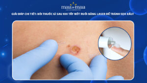 bôi thuốc gì sau khi tẩy nốt ruồi bằng laser