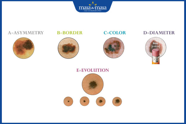 Cách nhận biết nốt ruồi ác tính hay nốt ruồi bình thường 3 cách nhận biết nốt ruồi ác tính