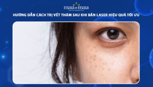 cách trị vết thâm sau khi bắn laser