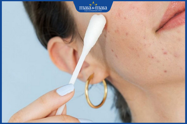 chấm axit nốt ruồi