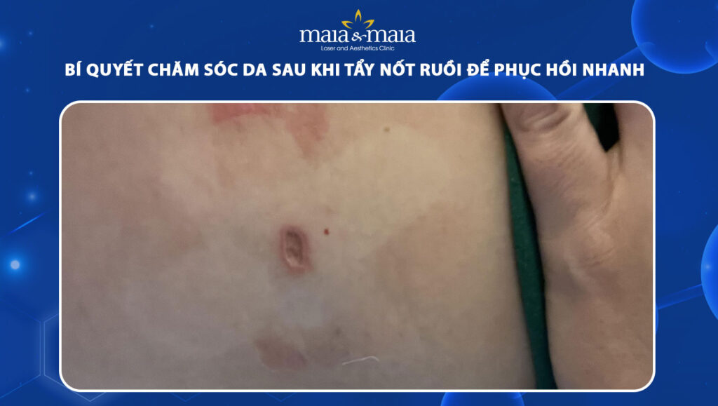 chăm sóc da sau khi tẩy nốt ruồi