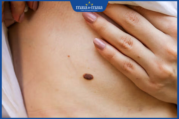 có nốt ruồi ở hông