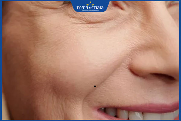 có nốt ruồi ở rãnh cười