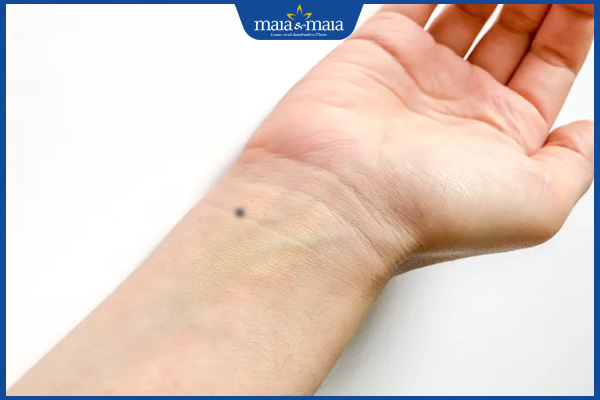 cổ tay có nốt ruồi