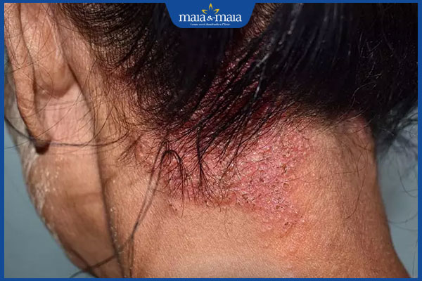 da đầu bị nhiễm trùng