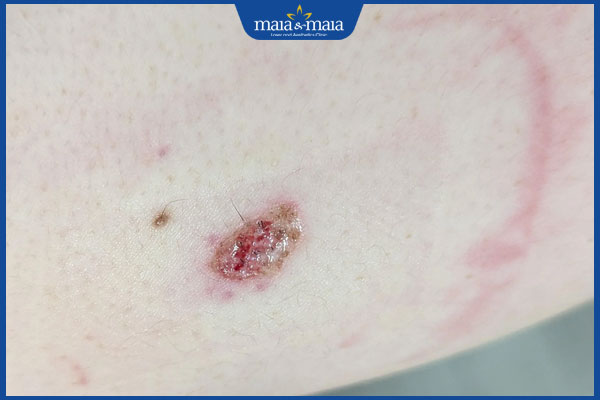 da sau tẩy nốt ruồi