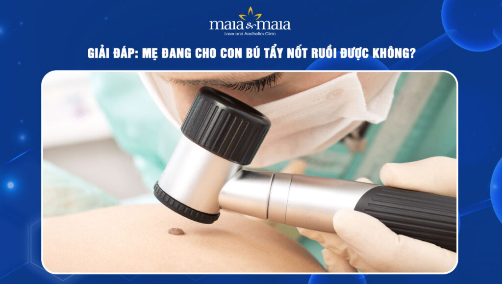 đang cho con bú tẩy nốt ruồi được không