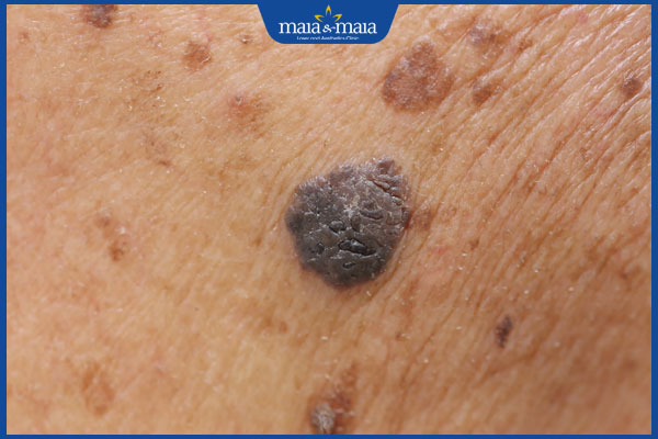 Nốt ruồi không điển hình nguy hiểm không? Dấu hiệu nhận biết 2 dấu hiệu nốt ruồi không điển hình