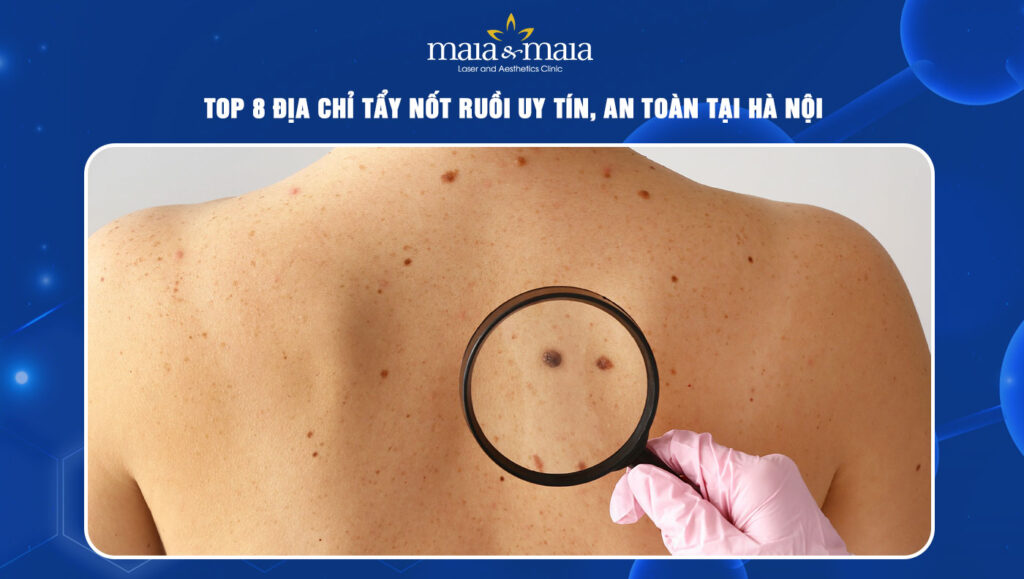 địa chỉ tẩy nốt ruồi