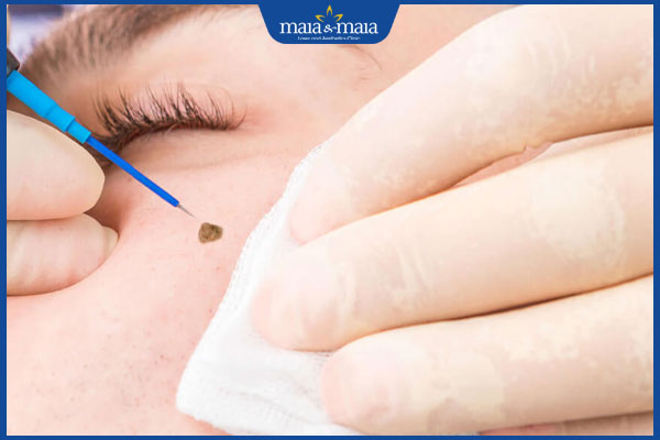 Tẩy nốt ruồi bằng đốt điện hiệu quả ra sao? Cần lưu ý gì? 2 đốt điện xóa nốt ruồi