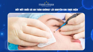 đốt nốt ruồi có an toàn không