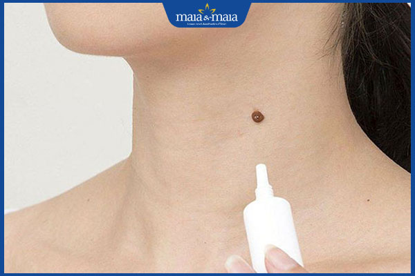 dùng kem tẩy nốt ruồi