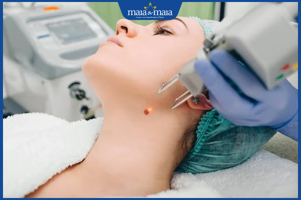 dùng laser tẩy nốt ruồi