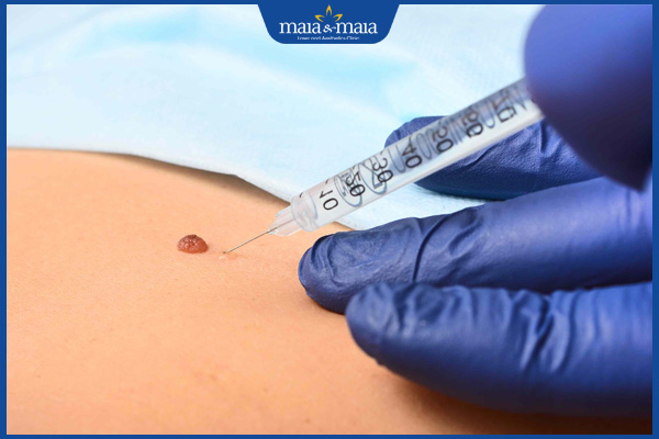 gây tê nốt ruồi