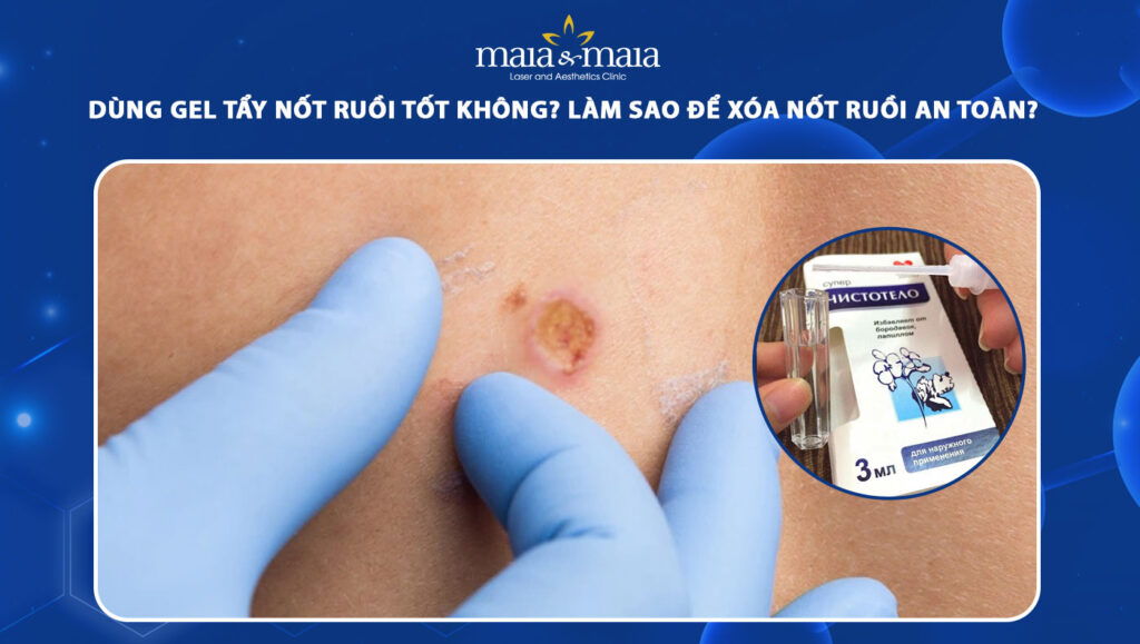 Dùng gel tẩy nốt ruồi tốt không? Cách xóa nốt ruồi an toàn 1 gel tẩy nốt ruồi