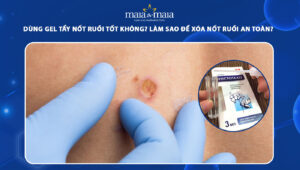 gel tẩy nốt ruồi