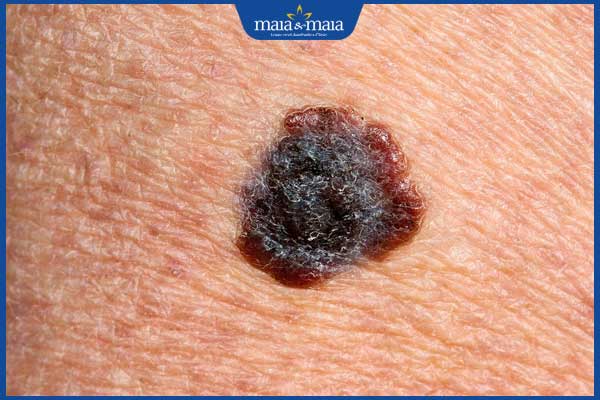 hình ảnh nốt ruồi ung thư hắc tố
