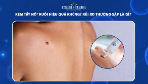 kem tẩy nốt ruồi