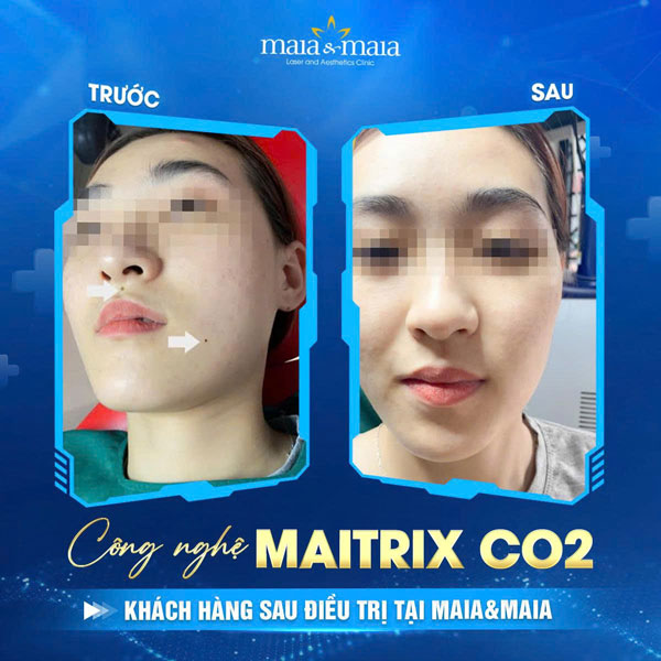 khách hàng tẩy nốt ruồi tại maia