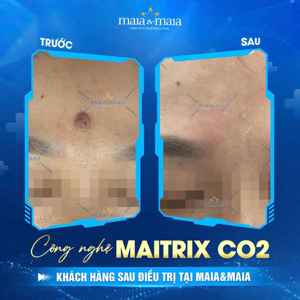 khách hàng xóa nốt ruồi tại maia